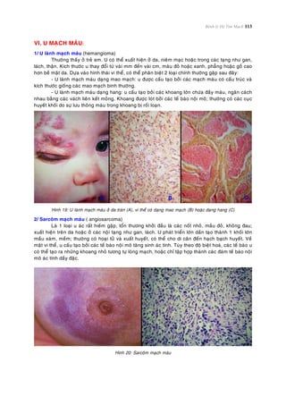 Bệnh lý Hệ Tim Mạch 113
VI. U MAÏCH MAÙU:
1/ U laønh maïch maùu (hemangioma)
Thöôøng thaáy ôû treû em. U coù theå xuaát hieän ôû da, nieâm maïc hoaëc trong caùc taïng nhö gan,
laùch, thaän. Kích thöôùc u thay ñoåi töø vaøi mm ñeán vaøi cm, maøu ñoû hoaëc xanh, phaúng hoaëc goà cao
hôn beà maët da. Döïa vaøo hình thaùi vi theå, coù theå phaân bieät 2 loaïi chính thöôøng gaëp sau ñaây:
- U laønh maïch maùu daïng mao maïch: u ñöôïc caáu taïo bôûi caùc maïch maùu coù caáu truùc vaø
kích thöôùc gioáng caùc mao maïch bình thöôøng.
- U laønh maïch maùu daïng hang: u caáu taïo bôûi caùc khoang lôùn chöùa ñaày maùu, ngaên caùch
nhau baèng caùc vaùch lieân keát moûng. Khoang ñöôïc loùt bôûi caùc teá baøo noäi moâ; thöôøng coù caùc cuïc
huyeát khoái do söï löu thoâng maùu trong khoang bò roái loaïn.
Hình 19: U laønh maïch maùu ôû da traùn (A), vi theå coù daïng mao maïch (B) hoaëc daïng hang (C)
2/ Sarcoâm maïch maùu ( angiosarcoma)
Laø 1 loaïi u aùc raát hieám gaëp, toån thöông khôûi ñaàu laø caùc noát nhoû, maàu ñoû, khoâng ñau;
xuaát hieän treân da hoaëc ôû caùc noäi taïng nhö gan, laùch. U phaùt trieån lôùn daàn taïo thaønh 1 khoái lôùn
maàu xaùm, meàm; thöôøng coù hoaïi töû vaø xuaát huyeát, coù theå cho di caên ñeán haïch baïch huyeát. Veà
maët vi theå, u caáu taïo bôûi caùc teá baøo noäi moâ taêng sinh aùc tính. Tuøy theo ñoä bieät hoaù, caùc teá baøo u
coù theå taïo ra nhöõng khoang nhoû töông töï loøng maïch, hoaëc chæ taäp hôïp thaønh caùc ñaùm teá baøo noäi
moâ aùc tính daày ñaëc.
Hình 20: Sarcoâm maïch maùu
 
