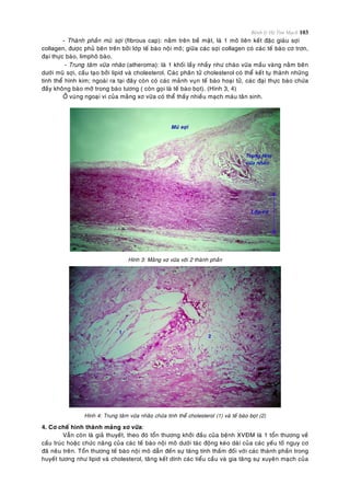 Bệnh lý Hệ Tim Mạch 103
- Thaønh phaàn muõ sôïi (fibrous cap): naèm treân beà maët, laø 1 moâ lieân keát ñaëc giaøu sôïi
collagen, ñöôïc phuû beân treân bôûi lôùp teá baøo noäi moâ; giöõa caùc sôïi collagen coù caùc teá baøo cô trôn,
ñaïi thöïc baøo, limphoâ baøo.
- Trung taâm vöõa nhaõo (atheroma): laø 1 khoái laày nhaày nhö chaùo vöõa maàu vaøng naèm beân
döôùi muõ sôïi, caáu taïo bôûi lipid vaø cholesterol. Caùc phaân töû cholesterol coù theå keát tuï thaønh nhöõng
tinh theå hình kim; ngoaøi ra taïi ñaây coøn coù caùc maûnh vuïn teá baøo hoaïi töû, caùc ñaïi thöïc baøo chöùa
ñaày khoâng baøo môõ trong baøo töông ( coøn goïi laø teá baøo boït). (Hình 3, 4)
ÔÛ vuøng ngoaïi vi cuûa maûng xô vöõa coù theå thaáy nhieàu maïch maùu taân sinh.
Hình 3: Maûng xô vöõa vôùi 2 thaønh phaàn
Hình 4: Trung taâm vöõa nhaõo chöùa tinh theå cholesterol (1) vaø teá baøo boït (2)
4. Cô cheá hình thaønh maûng xô vöõa:
Vaãn coøn laø giaû thuyeát, theo ñoù toån thöông khôûi ñaàu cuûa beänh XVÑM laø 1 toån thöông veà
caáu truùc hoaëc chöùc naêng cuûa caùc teá baøo noäi moâ döôùi taùc ñoäng keùo daøi cuûa caùc yeáu toá nguy cô
ñaõ neâu treân. Toån thöông teá baøo noäi moâ daãn ñeán söï taêng tính thaám ñoái vôùi caùc thaønh phaàn trong
huyeát töông nhö lipid vaø cholesterol, taêng keát dính caùc tieåu caàu vaø gia taêng söï xuyeân maïch cuûa
 