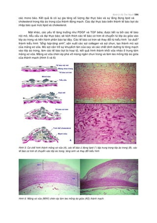 Bệnh lý Hệ Tim Mạch 104
caùc mono baøo. Keát quaû laø coù söï gia taêng soá löôïng ñaïi thöïc baøo vaø söï laéng ñoïng lipid vaø
cholesterol trong lôùp aùo trong cuûa thaønh ñoäng maïch. Caùc ñaïi thöïc baøo bieán thaønh teá baøo boït do
nhaäp baøo quaù möùc lipid vaø cholesterol.
Maët khaùc, caùc yeáu toá taêng tröôûng nhö PDGF vaø TGF beâta; ñöôïc tieát ra bôûi caùc teá baøo
noäi moâ, tieåu caàu vaø ñaïi thöïc baøo; seõ kích thích caùc teá baøo cô trôn di chuyeån töø lôùp aùo giöõa vaøo
lôùp aùo trong vaø tieán haønh phaân baøo taïi ñaây. Caùc teá baøo cô trôn seõ thay ñoåi töø kieåu hình "co duoãi"
thaønh kieåu hình "toång hôïp-taêng sinh", saûn xuaát caùc sôïi collagen vaø sôïi chun, taïo thaønh muõ sôïi
cuûa maûng xô vöõa. Muõ sôïi caûn trôû söï khuyeách taùn cuûa oxy vaø caùc chaát dinh döôõng töø loøng maïch
vaøo lôùp aùo trong, laøm caùc teá baøo boït bò hoaïi töû, keát quaû hình thaønh khoái vöõa nhaõo ôû trung taâm
maûng xô vöõa. Maûng xô vöõa cheøn eùp phaù vôõ maøng ngaên chun trong vaø laøm teo moûng lôùp aùo giöõa
cuûa thaønh maïch (Hình 5 vaø 6)
Hình 5: Cô cheá hình thaønh maûng xô vöõa (A), caùc teá baøo öù ñoïng lipid (*) taäp trung trong lôùp aùo trong (B), caùc
teá baøo cô trôn di chuyeån vaøo lôùp aùo trong, taêng sinh vaø thay ñoåi kieåu hình
Hình 6: Maûng xô vöõa (MXV) cheøn eùp laøm teo moûng aùo giöõa (AG) thaønh maïch.
 