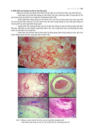 Bệnh lý Hệ Tim Mạch 105
5. Dieãn tieán cuûa maûng xô vöõa vaø caùc haäu quaû:
Maûng xô vöõa sau khi ñöôïc hình thaønh seõ lôùn daàn vaø coù theå chòu theâm caùc bieán ñoåi sau:
- Loeùt hoaëc nöùt vôõ beà maët maûng xô vöõa (Hình 7A), laøm chaát vöõa nhaõo ôû trung taâm bò rôùt
vaøo loøng maïch taïo thaønh cuïc huyeát taéc cholesterol (Hình 7B).
- Xuaát huyeát beân trong maûng xô vöõa (Hình 7C): do maùu töø loøng maïch chui vaøo qua choã
nöùt vôõ treân beà maët, hoaëc do vôõ caùc maïch maùu taân sinh trong maûng xô vöõa. Keát quaû maûng xô
vöõa bò phình to, laøm heïp theâm loøng maïch.
- Huyeát khoái: toån thöông teá baøo noäi moâ ôû beà maët maûng xô vöõa do loeùt seõ gaây keát dính
tieåu caàu, daãn ñeán söï hình thaønh huyeát khoái (Hình 7D). Cuïc huyeát khoái naøy coù theå bong vaøo loøng
maïch vaø trôû thaønh cuïc huyeát taéc.
- Calci hoùa: caùc teá baøo hoaïi töû kích thích söï laéng ñoïng calci trong maûng xô vöõa, laøm cho
thaønh ñoäng maïch trôû neân cöùng doøn deã vôõ (Hình 7E).
Hình 7: Maûng xô vöõa bò loeùt beà maët (A), taïo cuïc huyeát taéc cholesterol (B),
xuaát huyeát trong maûng xô vöõa (C), taïo huyeát khoái (D), laéng ñoïng calci (E)
 