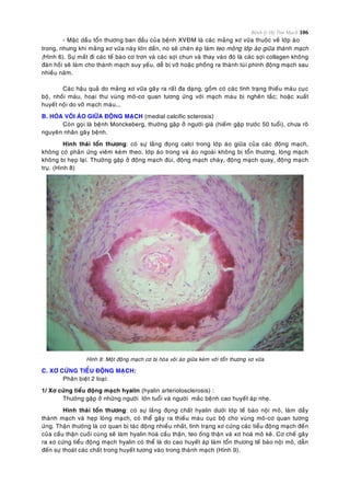 Bệnh lý Hệ Tim Mạch 106
- Maëc daàu toån thöông ban ñaàu cuûa beänh XVÑM laø caùc maûng xô vöõa thuoäc veà lôùp aùo
trong, nhöng khi maûng xô vöõa naøy lôùn daàn, noù seõ cheøn eùp laøm teo moûng lôùp aùo giöõa thaønh maïch
(Hình 6). Söï maát ñi caùc teá baøo cô trôn vaø caùc sôïi chun vaø thay vaøo ñoù laø caùc sôïi collagen khoâng
ñaøn hoài seõ laøm cho thaønh maïch suy yeáu, deã bò vôõ hoaëc phoàng ra thaønh tuùi phình ñoäng maïch sau
nhieàu naêm.
Caùc haäu quaû do maûng xô vöõa gaây ra raát ña daïng, goàm coù caùc tình traïng thieáu maùu cuïc
boä, nhoài maùu, hoaïi thö vuøng moâ-cô quan töông öùng vôùi maïch maùu bò ngheõn taéc; hoaëc xuaát
huyeát noäi do vôõ maïch maùu...
B. HOÙA VOÂI AÙO GIÖÕA ÑOÄNG MAÏCH (medial calcific sclerosis)
Coøn goïi laø beänh Monckeberg, thöôøng gaëp ôû ngöôøi giaø (hieám gaëp tröôùc 50 tuoåi), chöa roõ
nguyeân nhaân gaây beänh.
Hình thaùi toån thöông: coù söï laéng ñoïng calci trong lôùp aùo giöõa cuûa caùc ñoäng maïch,
khoâng coù phaûn öùng vieâm keøm theo, lôùp aùo trong vaø aùo ngoaøi khoâng bò toån thöông, loøng maïch
khoâng bò heïp laïi. Thöôøng gaëp ôû ñoäng maïch ñuøi, ñoäng maïch chaøy, ñoäng maïch quay, ñoäng maïch
truï. (Hình 8)
Hình 8: Moät ñoäng maïch cô bò hoùa voâi aùo giöõa keøm vôùi toån thöông xô vöõa
C. XÔ CÖÙNG TIEÅU ÑOÄNG MAÏCH:
Phaân bieät 2 loaïi:
1/ Xô cöùng tieåu ñoäng maïch hyalin (hyalin arteriolosclerosis) :
Thöôøng gaëp ôû nhöõng ngöôøi lôùn tuoåi vaø ngöôøi maéc beänh cao huyeát aùp nheï.
Hình thaùi toån thöông: coù söï laéng ñoïng chaát hyalin döôùi lôùp teá baøo noäi moâ, laøm daày
thaønh maïch vaø heïp loøng maïch, coù theå gaây ra thieáu maùu cuïc boä cho vuøng moâ-cô quan töông
öùng. Thaän thöôøng laø cô quan bò taùc ñoäng nhieàu nhaát, tình traïng xô cöùng caùc tieåu ñoäng maïch ñeán
cuûa caàu thaän cuoái cuøng seõ laøm hyalin hoaù caàu thaän, teo oáng thaän vaø xô hoaù moâ keõ. Cô cheá gaây
ra xô cöùng tieåu ñoäng maïch hyalin coù theå laø do cao huyeát aùp laøm toån thöông teá baøo noäi moâ, daãn
ñeán söï thoaùt caùc chaát trong huyeát töông vaøo trong thaønh maïch (Hình 9).
 