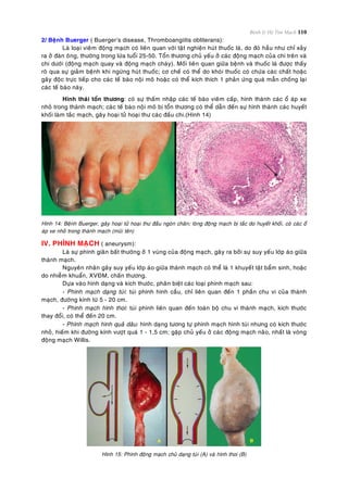 Bệnh lý Hệ Tim Mạch 110
2/ Beänh Buerger ( Buerger’s disease, Thromboangiitis obliterans):
Laø loaïi vieâm ñoäng maïch coù lieân quan vôùi taät nghieän huùt thuoác laù, do ñoù haàu nhö chæ xaûy
ra ôû ñaøn oâng, thöôøng trong löùa tuoåi 25-50. Toån thöông chuû yeáu ôû caùc ñoäng maïch cuûa chi treân vaø
chi döôùi (ñoäng maïch quay vaø ñoäng maïch chaøy). Moái lieân quan giöõa beänh vaø thuoác laù ñöôïc thaáy
roõ qua söï giaûm beänh khi ngöøng huùt thuoác; cô cheá coù theå do khoùi thuoác coù chöùa caùc chaát hoaëc
gaây ñoäc tröïc tieáp cho caùc teá baøo noäi moâ hoaëc coù theå kích thích 1 phaûn öùng quaù maãn choáng laïi
caùc teá baøo naøy.
Hình thaùi toån thöông: coù söï thaám nhaäp caùc teá baøo vieâm caáp, hình thaønh caùc oå aùp xe
nhoû trong thaønh maïch; caùc teá baøo noäi moâ bò toån thöông coù theå daãn ñeán söï hình thaønh caùc huyeát
khoái laøm taéc maïch, gaây hoaïi töû hoaïi thö caùc ñaàu chi.(Hình 14)
Hình 14: Beänh Buerger, gaây hoaïi töû hoaïi thö ñaàu ngoùn chaân; loøng ñoäng maïch bò taéc do huyeát khoái, coù caùc oå
aùp xe nhoû trong thaønh maïch (muõi teân)
IV. PHÌNH MAÏCH ( aneurysm):
Laø söï phình giaõn baát thöôøng ôû 1 vuøng cuûa ñoäng maïch, gaây ra bôûi söï suy yeáu lôùp aùo giöõa
thaønh maïch.
Nguyeân nhaân gaây suy yeáu lôùp aùo giöõa thaønh maïch coù theå laø 1 khuyeát taät baåm sinh, hoaëc
do nhieãm khuaån, XVÑM, chaán thöông.
Döïa vaøo hình daïng vaø kích thöôùc, phaân bieät caùc loaïi phình maïch sau:
- Phình maïch daïng tuùi: tuùi phình hình caàu, chæ lieân quan ñeán 1 phaàn chu vi cuûa thaønh
maïch, ñöôøng kính töø 5 - 20 cm.
- Phình maïch hình thoi: tuùi phình lieân quan ñeán toaøn boä chu vi thaønh maïch, kích thöôùc
thay ñoåi, coù theå ñeán 20 cm.
- Phình maïch hình quaû daâu: hình daïng töông töï phình maïch hình tuùi nhöng coù kích thöôùc
nhoû, hieám khi ñöôøng kính vöôït quaù 1 - 1,5 cm; gaëp chuû yeáu ôû caùc ñoäng maïch naõo, nhaát laø voøng
ñoäng maïch Willis.
Hình 15: Phình ñoäng maïch chuû daïng tuùi (A) vaø hình thoi (B)
 