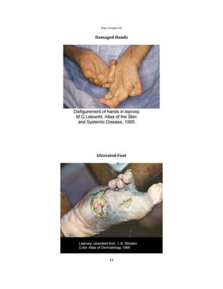 15
http://images.md
Damaged Hands
Ulcerated Foot
 