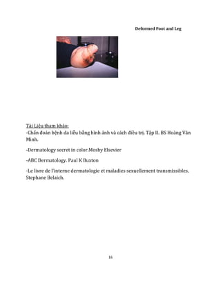 16
Deformed Foot and Leg
Tài Liệu tham khảo:
-Chẩn đoán bệnh da liễu bằng hình ảnh và cách điều trị. Tập II. BS Hoàng Văn
Minh.
-Dermatology secret in color.Mosby Elsevier
-ABC Dermatology. Paul K Buxton
-Le livre de l’interne dermatologie et maladies sexuellement transmissibles.
Stephane Belaich.
 
