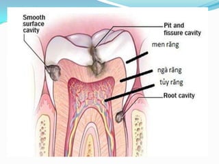 Bệnh sâu răng | PPTX