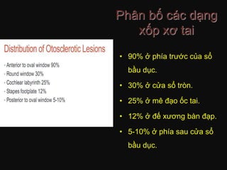 Phân bố các dạng
xốp xơ tai
• 90% ở phía trước của sổ
bầu dục.
• 30% ở cửa sổ tròn.
• 25% ở mê đạo ốc tai.
• 12% ở đế xương bàn đạp.
• 5-10% ở phía sau cửa sổ
bầu dục.
 