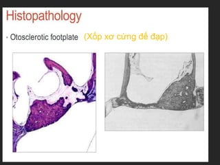 (Xốp xơ cứng đế đạp)
 