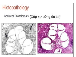 (Xốp xơ cứng ốc tai)
 