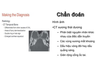 Hình ảnh
•CT xương thái dương
– Phân biệt nguyên nhân khác
nhau của điếc dẫn truyền
– Các vùng xương mất khoáng
– Dấu hiệu vòng đôi hay dấu
quầng sáng.
– Giãn rộng cống ốc tai.
 