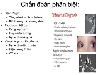 Chẩn đoán phân biệt:
• Bệnh Paget:
– Tăng Alkaline phosphatase
– Bất thường các xương khác
• Tạo xương bất toàn:
– Củng mạc xanh
– Gãy nhiều xương
– Nghe kém tăng dần
• Khuyết ống bán khuyên trên:
– Nghe kém dẫn truyền
– Hiện tượng Tullio
– CT scan
 