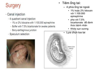• Tiêm ống tai:
– 4 phía ống tai ngoài
• 1% hoặc 2% lidocain
với 1:100.000
epinephrine
• pha với 7,5%
bicarbonate để đánh
thức bệnh nhân
• Khớp sụn xương
– Lựa chọn loa tai
 