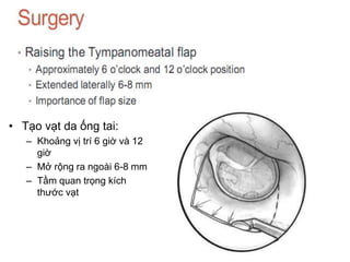 • Tạo vạt da ống tai:
– Khoảng vị trí 6 giờ và 12
giờ
– Mở rộng ra ngoài 6-8 mm
– Tầm quan trọng kích
thước vạt
 