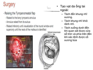 • Tạo vạt da ống tai
ngoài:
– Tách đến khung nhĩ
xương.
– Tách khung nhĩ khỏi
rãnh nhĩ.
– Tách xuống dưới đến
khi quan sát được cửa
sổ tròn và phía trên đến
khi xác định được cổ
xương búa
 