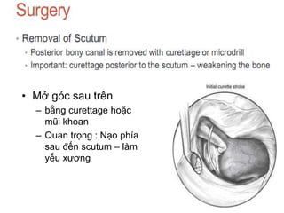 • Mở góc sau trên
– bằng curettage hoặc
mũi khoan
– Quan trọng : Nạo phía
sau đến scutum – làm
yếu xương
 