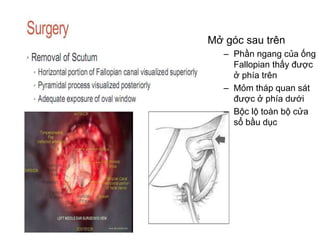 Mở góc sau trên
– Phần ngang của ống
Fallopian thấy được
ở phía trên
– Mỏm tháp quan sát
được ở phía dưới
– Bộc lộ toàn bộ cửa
sổ bầu dục
 