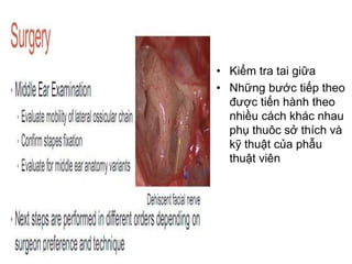 • Kiểm tra tai giữa
• Những bước tiếp theo
được tiến hành theo
nhiều cách khác nhau
phụ thuôc sở thích và
kỹ thuật của phẫu
thuật viên
 