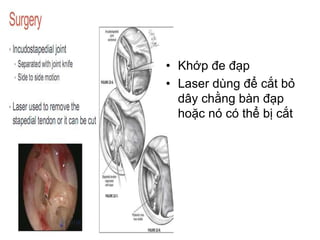 • Khớp đe đạp
• Laser dùng để cắt bỏ
dây chằng bàn đạp
hoặc nó có thể bị cắt
 