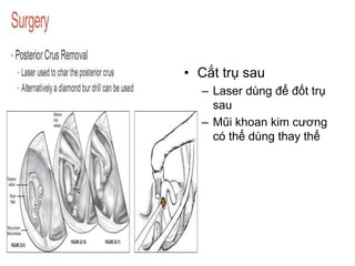 • Cắt trụ sau
– Laser dùng để đốt trụ
sau
– Mũi khoan kim cương
có thể dùng thay thế
 
