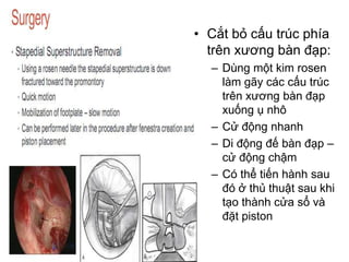 • Cắt bỏ cấu trúc phía
trên xương bàn đạp:
– Dùng một kim rosen
làm gãy các cấu trúc
trên xương bàn đạp
xuống ụ nhô
– Cử động nhanh
– Di động đế bàn đạp –
cử động chậm
– Có thể tiến hành sau
đó ở thủ thuật sau khi
tạo thành cửa sổ và
đặt piston
 