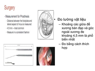 • Đo lường vật liệu
– Khoảng các giữa đế
xương bàn đạp và góc
ngoài xương đe
khoảng 4,5 mm là phổ
biến nhất
– Đo bằng cách thích
hợp
 
