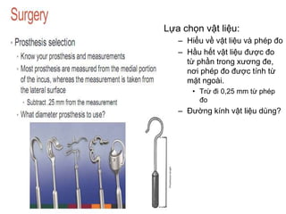 Lựa chọn vật liệu:
– Hiểu về vật liệu và phép đo
– Hầu hết vật liệu được đo
từ phần trong xương đe,
nơi phép đo được tính từ
mặt ngoài.
• Trừ đi 0,25 mm từ phép
đo
– Đường kính vật liệu dùng?
 