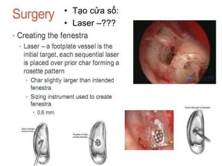 • Tạo cửa sổ:
• Laser –???
 