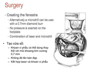 • Tạo cửa sổ:
– Khoan vi phẫu có thể dùng thay
thế với mũi khoang kim cương
0,7 mm
– Không đè lên bàn đạp
– Kết hợp laser và khoan vi phẫu
 