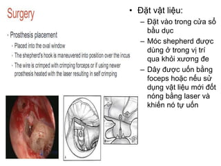 • Đặt vật liệu:
– Đặt vào trong cửa sổ
bầu dục
– Móc shepherd được
dùng ở trong vị trí
qua khỏi xương đe
– Dây được uốn bằng
foceps hoặc nếu sử
dụng vật liệu mới đốt
nóng bằng laser và
khiến nó tự uốn
 