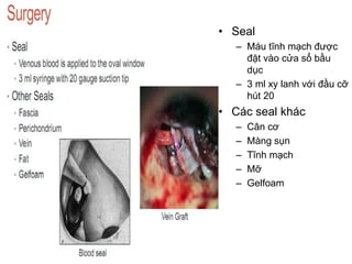 • Seal
– Máu tĩnh mạch được
đặt vào cửa sổ bầu
dục
– 3 ml xy lanh với đầu cỡ
hút 20
• Các seal khác
– Cân cơ
– Màng sụn
– Tĩnh mạch
– Mỡ
– Gelfoam
 