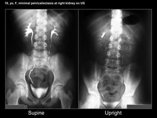 10, yo, F, minimal pelvicaliectasia at right kidney on US
Supine Upright
 