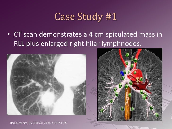 Lung Cancer Navigation