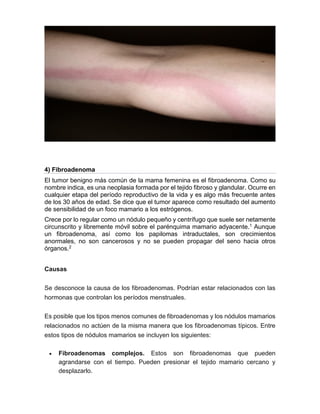 4) Fibroadenoma
El tumor benigno más común de la mama femenina es el fibroadenoma. Como su
nombre indica, es una neoplasia formada por el tejido fibroso y glandular. Ocurre en
cualquier etapa del período reproductivo de la vida y es algo más frecuente antes
de los 30 años de edad. Se dice que el tumor aparece como resultado del aumento
de sensibilidad de un foco mamario a los estrógenos.
Crece por lo regular como un nódulo pequeño y centrífugo que suele ser netamente
circunscrito y libremente móvil sobre el parénquima mamario adyacente.1 Aunque
un fibroadenoma, así como los papilomas intraductales, son crecimientos
anormales, no son cancerosos y no se pueden propagar del seno hacia otros
órganos.2
Causas
Se desconoce la causa de los fibroadenomas. Podrían estar relacionados con las
hormonas que controlan los períodos menstruales.
Es posible que los tipos menos comunes de fibroadenomas y los nódulos mamarios
relacionados no actúen de la misma manera que los fibroadenomas típicos. Entre
estos tipos de nódulos mamarios se incluyen los siguientes:
 Fibroadenomas complejos. Estos son fibroadenomas que pueden
agrandarse con el tiempo. Pueden presionar el tejido mamario cercano y
desplazarlo.
 