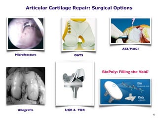 BioPoly - ISAKOS Cartilage Symposium - Shanghai June 2017 | PDF