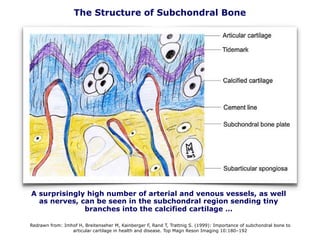 The Structure of Subchondral Bone
Redrawn from: Imhof H, Breitenseher M, Kainberger F, Rand T, Trattnig S. (1999): Importance of subchondral bone to
articular cartilage in health and disease. Top Magn Reson Imaging 10:180–192
A surprisingly high number of arterial and venous vessels, as well
as nerves, can be seen in the subchondral region sending tiny
branches into the calcified cartilage …
 