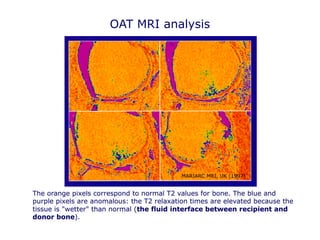 MARIARC MRI, UK (1997)
The orange pixels correspond to normal T2 values for bone. The blue and
purple pixels are anomalous: the T2 relaxation times are elevated because the
tissue is "wetter" than normal (the fluid interface between recipient and
donor bone).
OAT MRI analysis
 