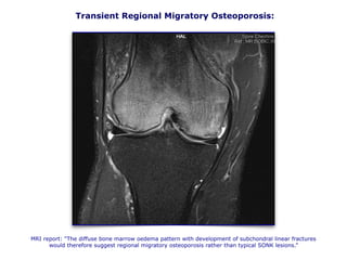 Transient Regional Migratory Osteoporosis:
MRI report: “The diffuse bone marrow oedema pattern with development of subchondral linear fractures
would therefore suggest regional migratory osteoporosis rather than typical SONK lesions.”
 