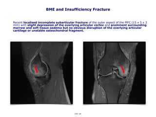 BME and Insufficiency Fracture
Recent localised incomplete subarticular fracture of the outer aspect of the MFC (15 x 5 x 3
mm) with slight depression of the overlying articular cortex and prominent surrounding
marrow and soft tissue oedema but no obvious disruption of the overlying articular
cartilage or unstable osteochondral fragment.
CKC UK
 