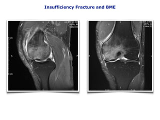 Insufficiency Fracture and BME
 