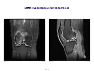 SONK (Spontaneous Osteonecrosis)
CKC UK
 