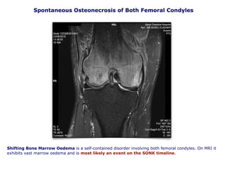Spontaneous Osteonecrosis of Both Femoral Condyles
Shifting Bone Marrow Oedema is a self-contained disorder involving both femoral condyles. On MRI it
exhibits vast marrow oedema and is most likely an event on the SONK timeline.
 