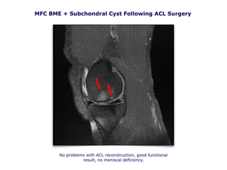 MFC BME + Subchondral Cyst Following ACL Surgery
No problems with ACL reconstruction, good functional
result, no meniscal deficiency.
 