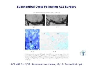 ACI MRI FU: 3/12: Bone marrow edema, 12/12: Subcortical cyst
Subchondral Cysts Following ACI Surgery
 