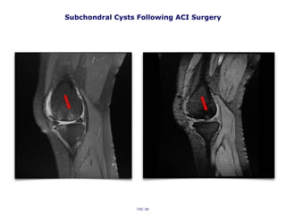 Subchondral Cysts Following ACI Surgery
CKC UK
 