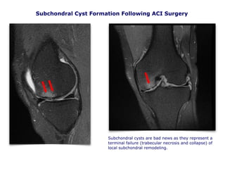 Subchondral Cyst Formation Following ACI Surgery
Subchondral cysts are bad news as they represent a
terminal failure (trabecular necrosis and collapse) of
local subchondral remodeling.
 