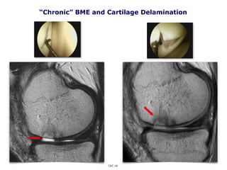 “Chronic” BME and Cartilage Delamination
CKC UK
 
