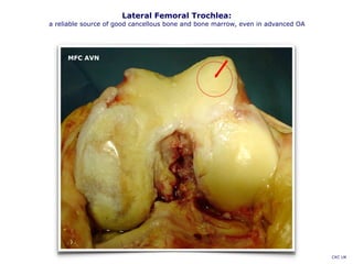 Lateral Femoral Trochlea:
a reliable source of good cancellous bone and bone marrow, even in advanced OA
CKC UK
MFC AVN
 