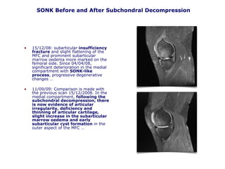 SONK Before and After Subchondral Decompression
• 15/12/08: subarticular insufficiency
fracture and slight flattening of the
MFC and prominent subarticular
marrow oedema more marked on the
femoral side. Since 04/04/08,
significant deterioration in the medial
compartment with SONK-like
process, progressive degenerative
changes …
• 11/09/09: Comparison is made with
the previous scan 15/12/2008. In the
medial compartment, following the
subchondral decompression, there
is now evidence of articular
irregularity, deficiency and
thinning of articular cartilage,
slight increase in the subarticular
marrow oedema and early
subarticular cyst formation in the
outer aspect of the MFC …
 
