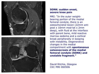 SONK: sudden onset,
severe knee pain
MRI: “In the outer weight-
bearing portion of the medial
femoral condyle, there is an
osteochondral lesion (22mm ant-
post x 10mm med-lat x 2mm
deep), with fluid at the interface
with parent bone, mild reactive
marrow oedema and a cortical
break peripherally in keeping
with instability. Degenerative
changes in the medial
compartment with spontaneous
osteonecrosis of the medial
femoral condyle (SONK) and
unstable fragment.”
David Ritchie, Glasgow
CKC MRI 060506
 