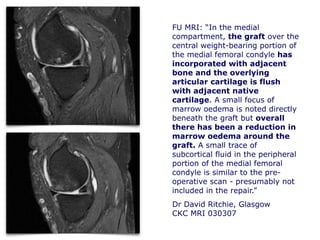 FU MRI: “In the medial
compartment, the graft over the
central weight-bearing portion of
the medial femoral condyle has
incorporated with adjacent
bone and the overlying
articular cartilage is flush
with adjacent native
cartilage. A small focus of
marrow oedema is noted directly
beneath the graft but overall
there has been a reduction in
marrow oedema around the
graft. A small trace of
subcortical fluid in the peripheral
portion of the medial femoral
condyle is similar to the pre-
operative scan - presumably not
included in the repair.”
Dr David Ritchie, Glasgow
CKC MRI 030307
 