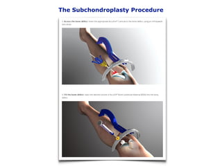The Subchondroplasty Procedure
 